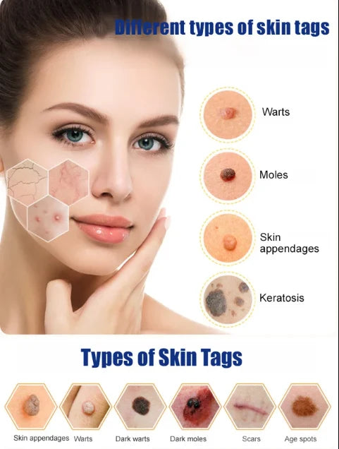 Wart Remover Gel