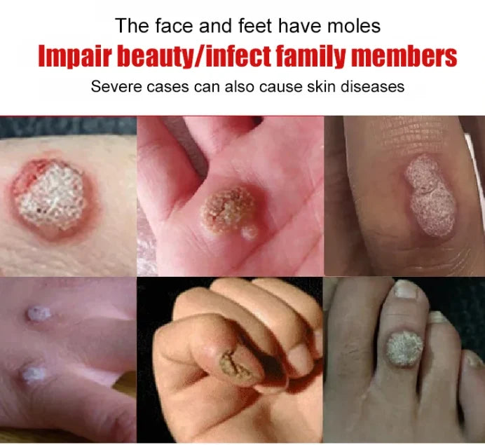 Wart Remover Gel
